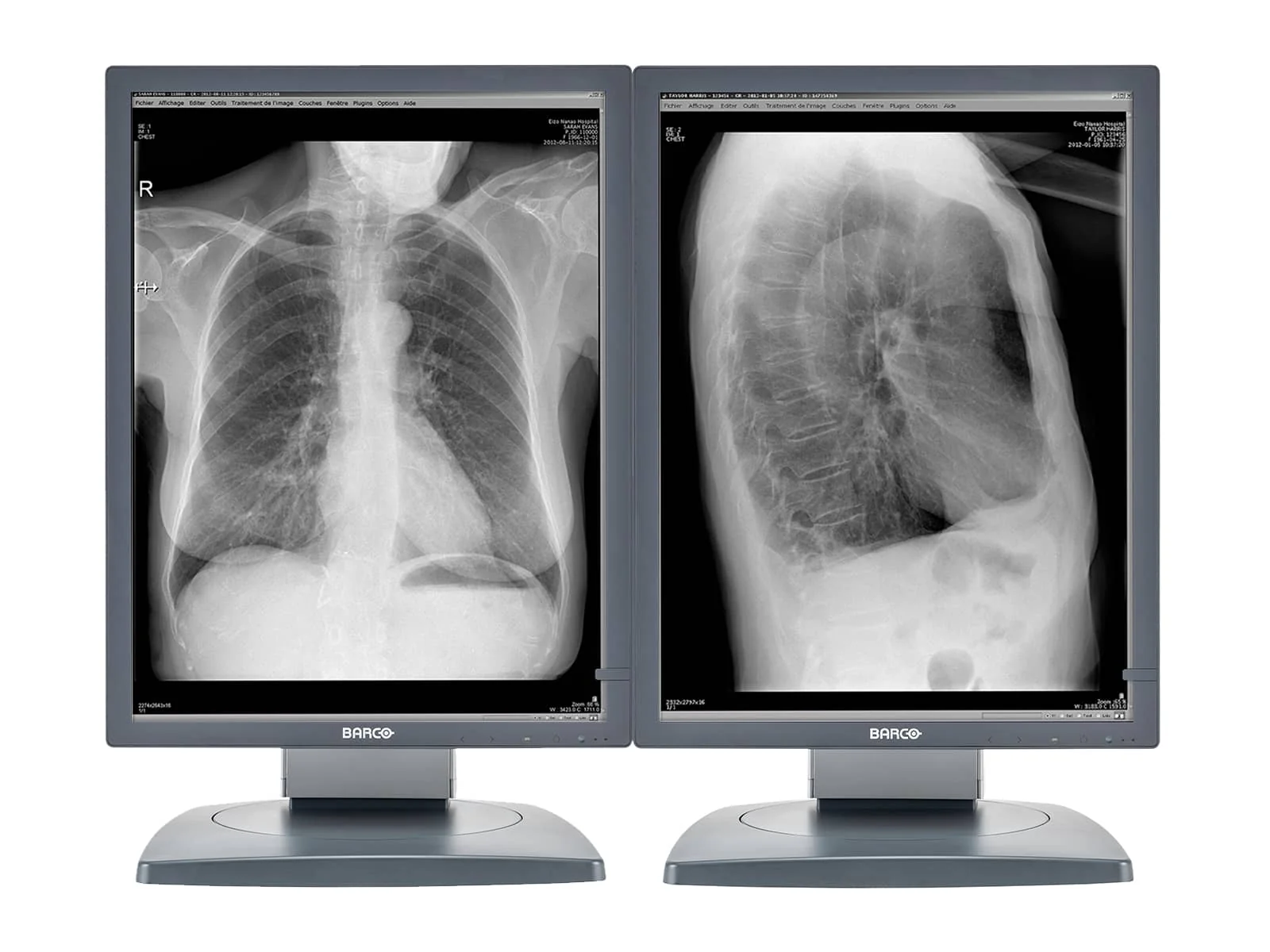 Barco Coronis MDCG-3120 3MP 20.8" Grayscale General Radiology Diagnostic Display