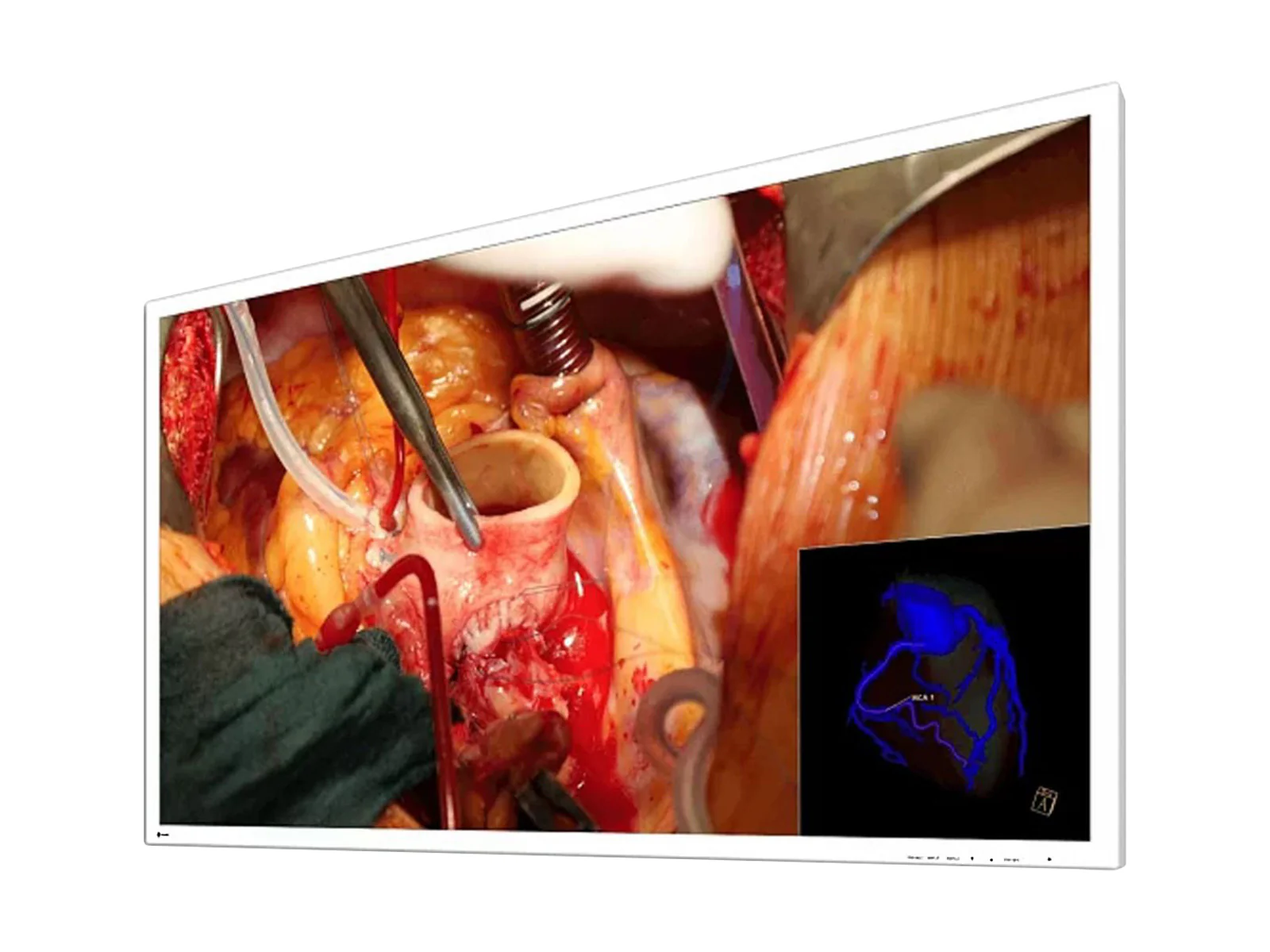 Eizo CuratOR 58" UHD 4K LED Surgical Display (EX5841) - Image 2